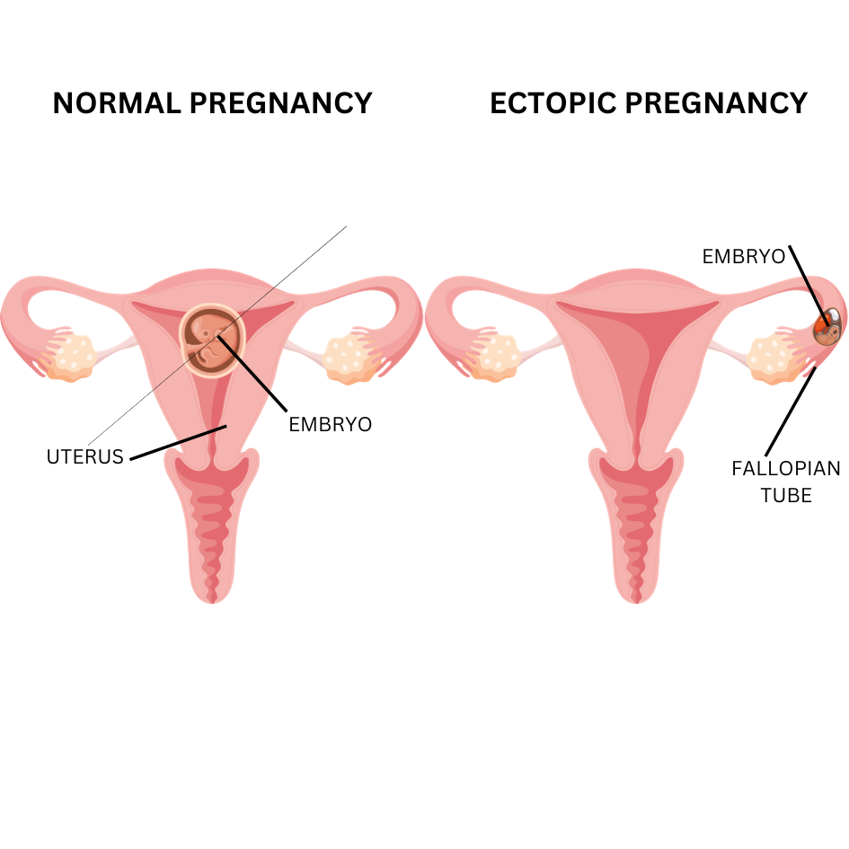 Ectopic pregnancy : causes symptoms and treatment by little govinda